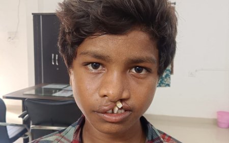 आरबीएसके के चिरायु दल ने जन्मजात कटे होंठ और तालु से पीड़ित बालक को दी नई मुस्कान