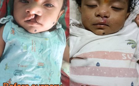 चिरायु टीम की पहल से तीन माह के मासूम का सफल ऑपरेशन, जन्मजात कटे होंठ से मिली राहत