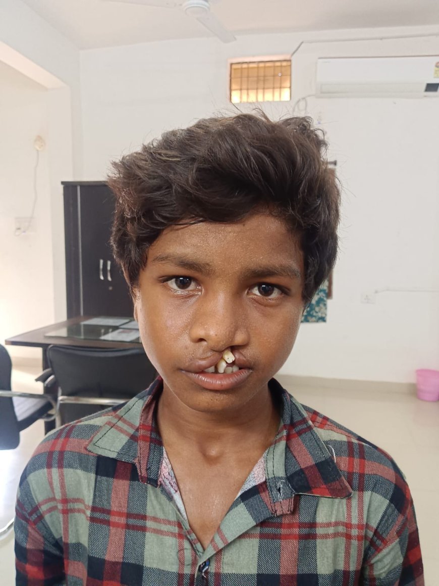 आरबीएसके के चिरायु दल ने जन्मजात कटे होंठ और तालु से पीड़ित बालक को दी नई मुस्कान