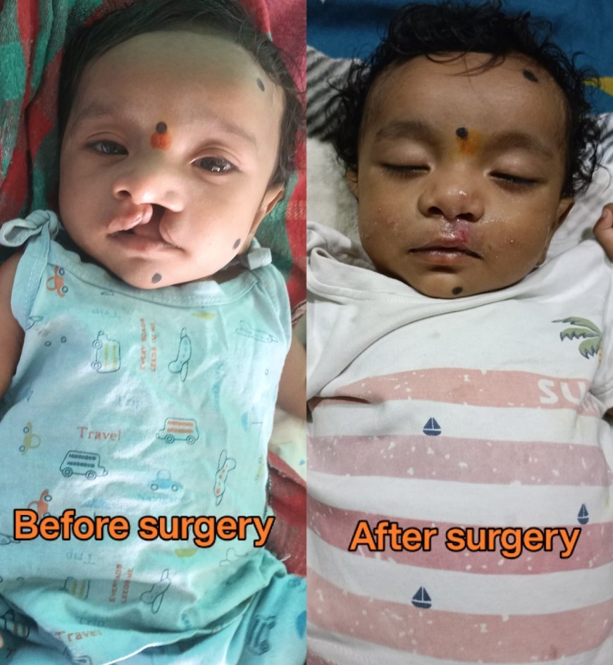 चिरायु टीम की पहल से तीन माह के मासूम का सफल ऑपरेशन, जन्मजात कटे होंठ से मिली राहत