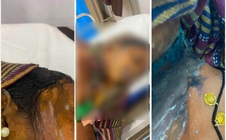 दुर्ग में कांवड़ यात्रा पर निकली महिला पर एसिड अटैक, चेहरा झुलसा; दो बच्चे भी चपेट में