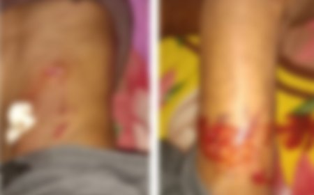भालू के हमले में ग्रामीण घायल, पुल नहीं होने से स्ट्रेचर से नदी पार कराकर पहुंचाया अस्पताल