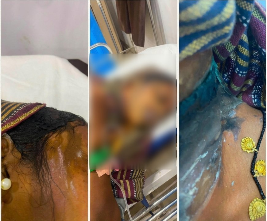 दुर्ग में कांवड़ यात्रा पर निकली महिला पर एसिड अटैक, चेहरा झुलसा; दो बच्चे भी चपेट में