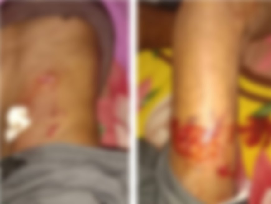 भालू के हमले में ग्रामीण घायल, पुल नहीं होने से स्ट्रेचर से नदी पार कराकर पहुंचाया अस्पताल
