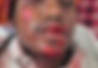 जर्जर पुल के गड्ढे में बाइक अनियंत्रित, युवक गंभीर घायल; हायर सेंटर रेफर