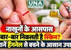 नाखूनों के आसपास बार-बार निकलती है स्किन? जानें हैंगनेल से बचने के आसान उपाय